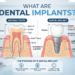dental implants
